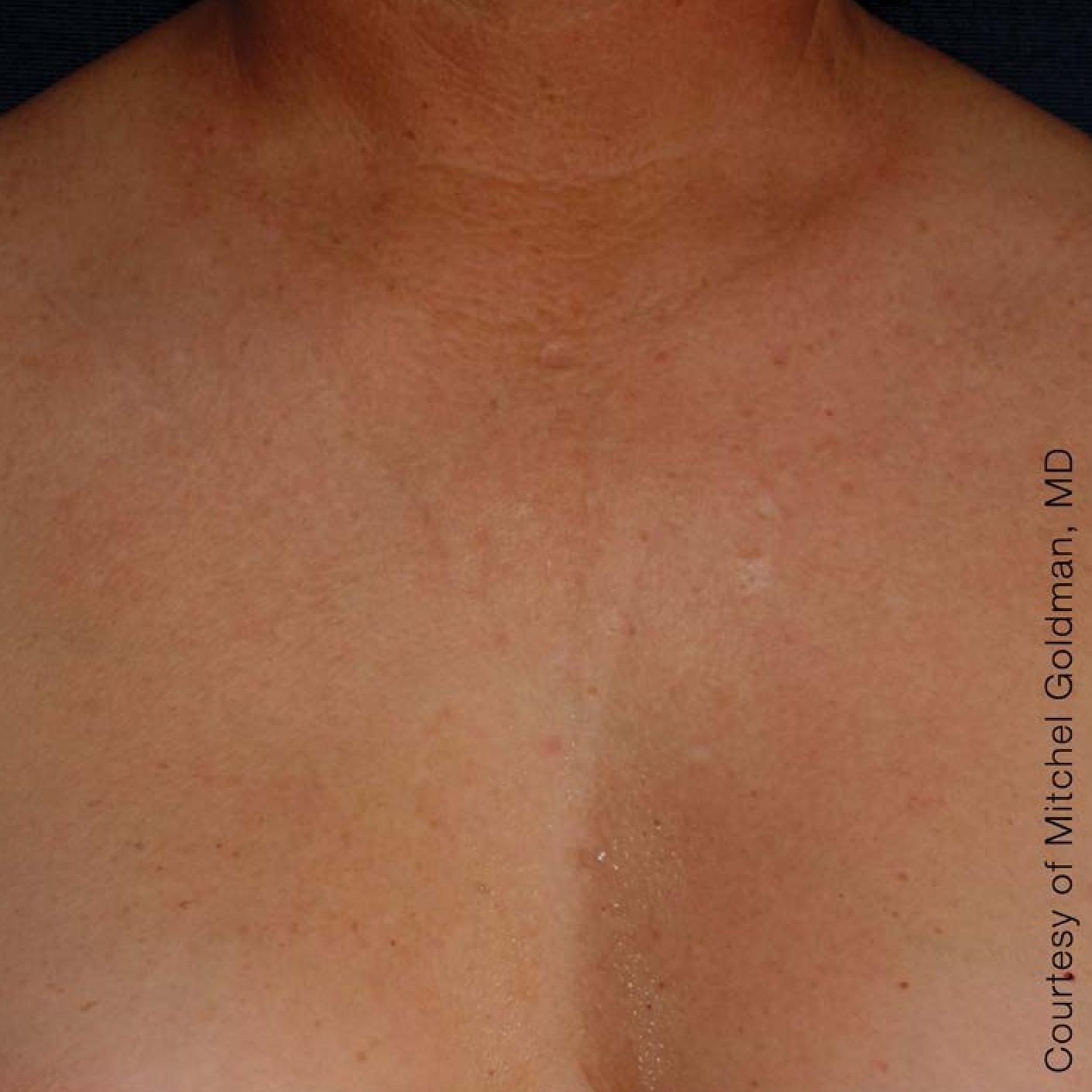 Ultherapy® - Décolletage: Patient 2 - After  