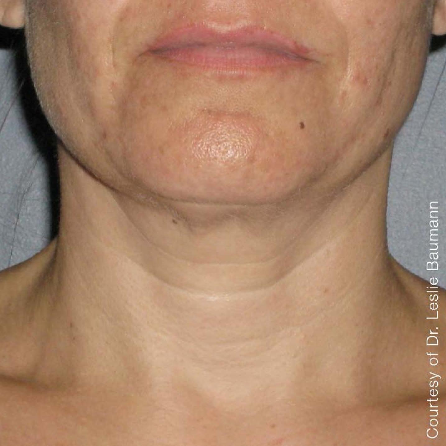 Ultherapy® - Neck: Patient 3 - After 1