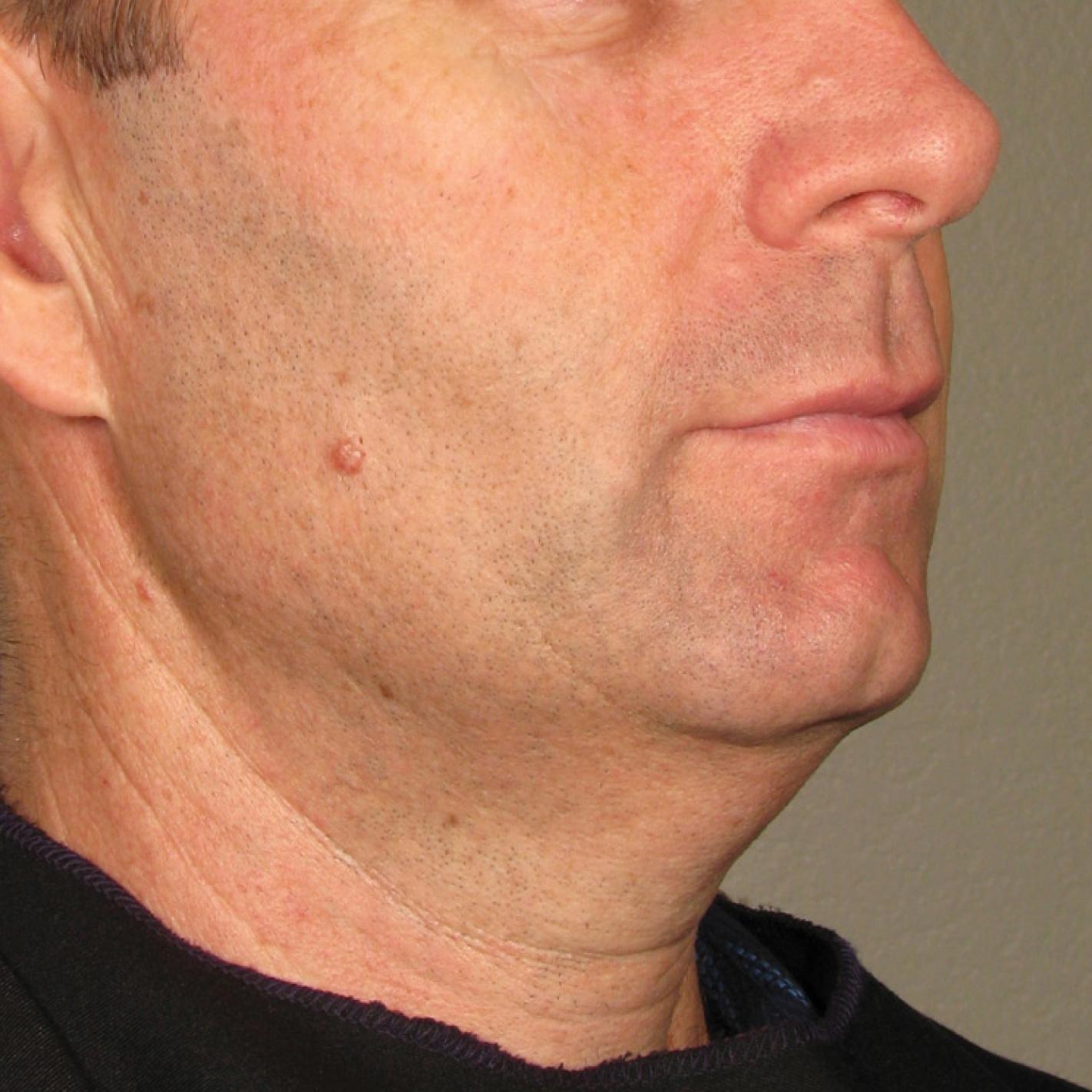 Ultherapy® - Chin: Patient 22 - Before 