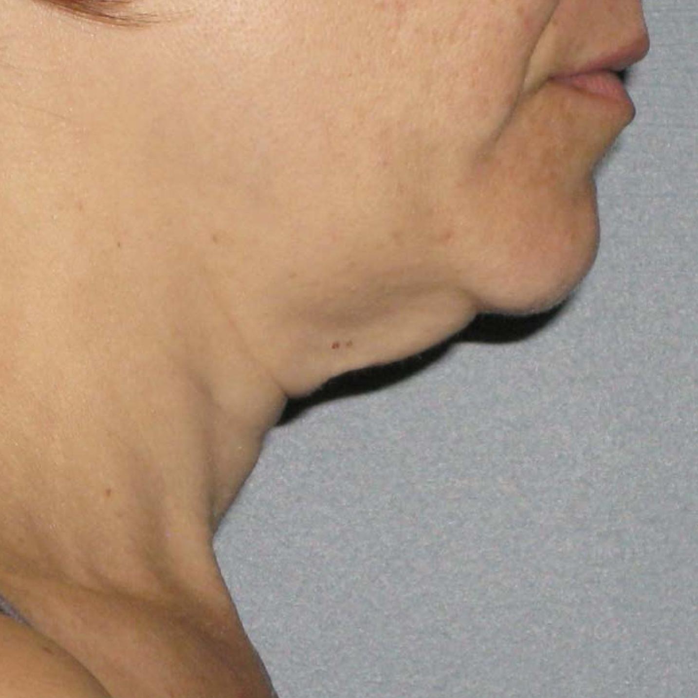 Ultherapy® - Neck: Patient 4 - Before 