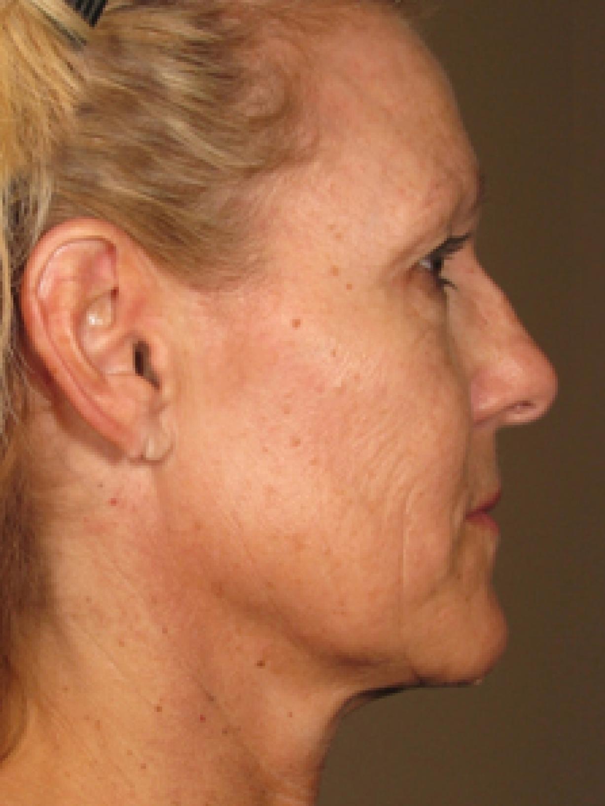 Ultherapy® - Face: Patient 5 - After  