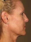 Ultherapy® - Face: Patient 5 - After 