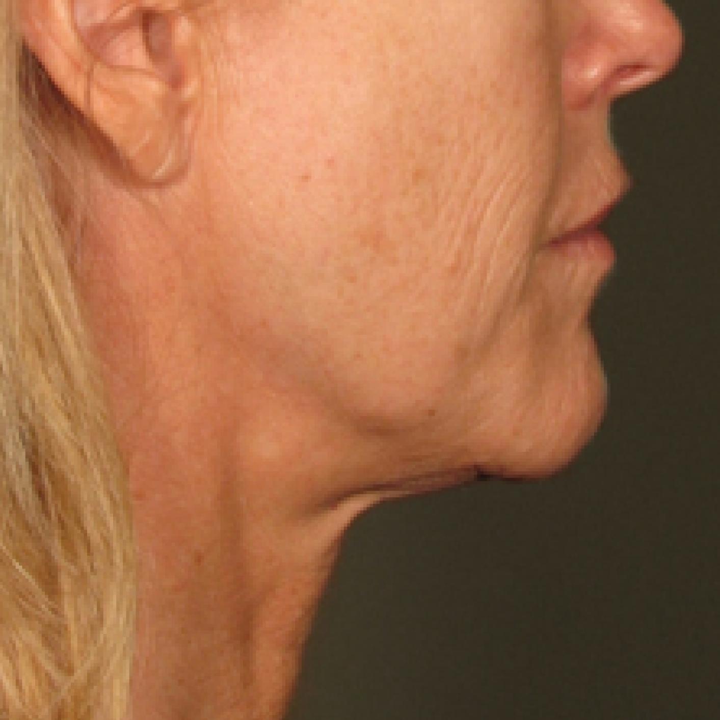Ultherapy® - Chin: Patient 17 - After 1