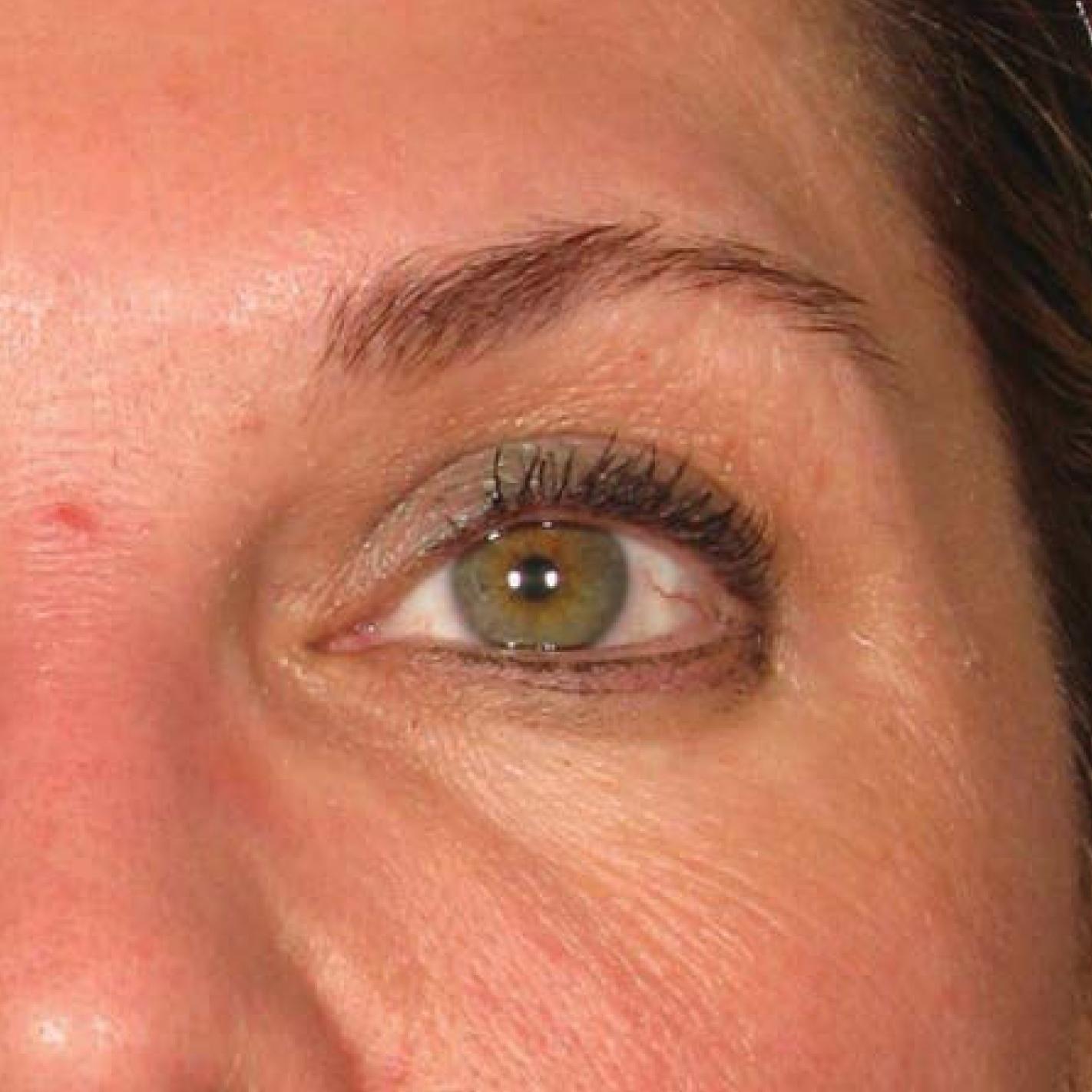 Ultherapy® - Brow: Patient 12 - After 