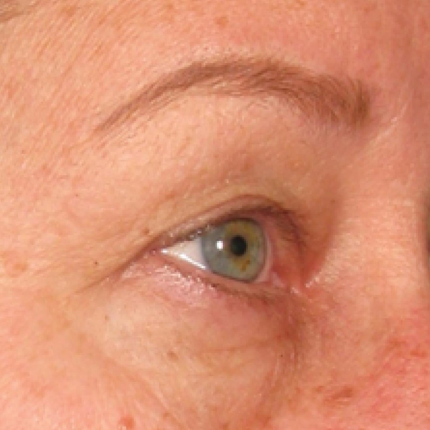 Ultherapy® - Brow: Patient 4 - After  