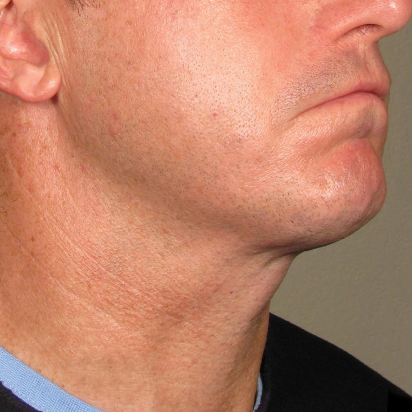 Ultherapy® - Chin: Patient 33 - After 1