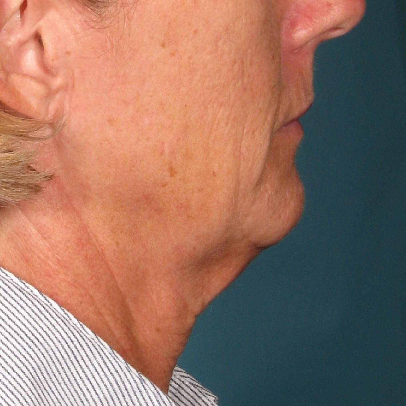 Ultherapy® - Chin: Patient 35 - Before 