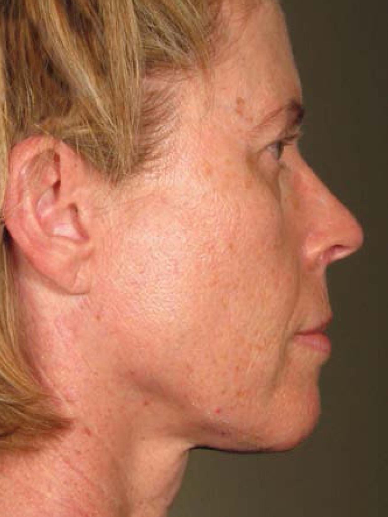 Ultherapy® - Face: Patient 20 - After 1