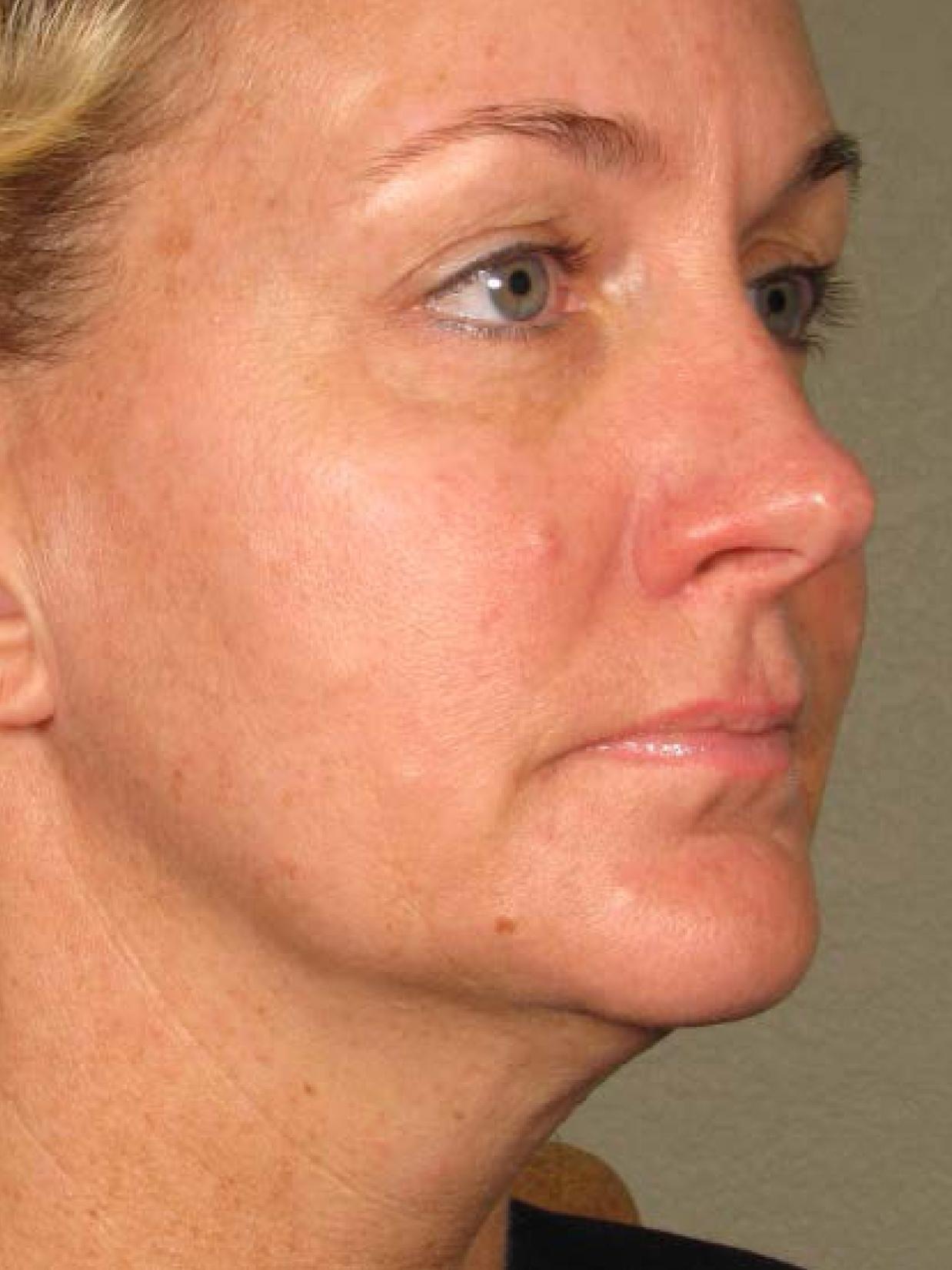 Ultherapy® - Face: Patient 12 - Before 