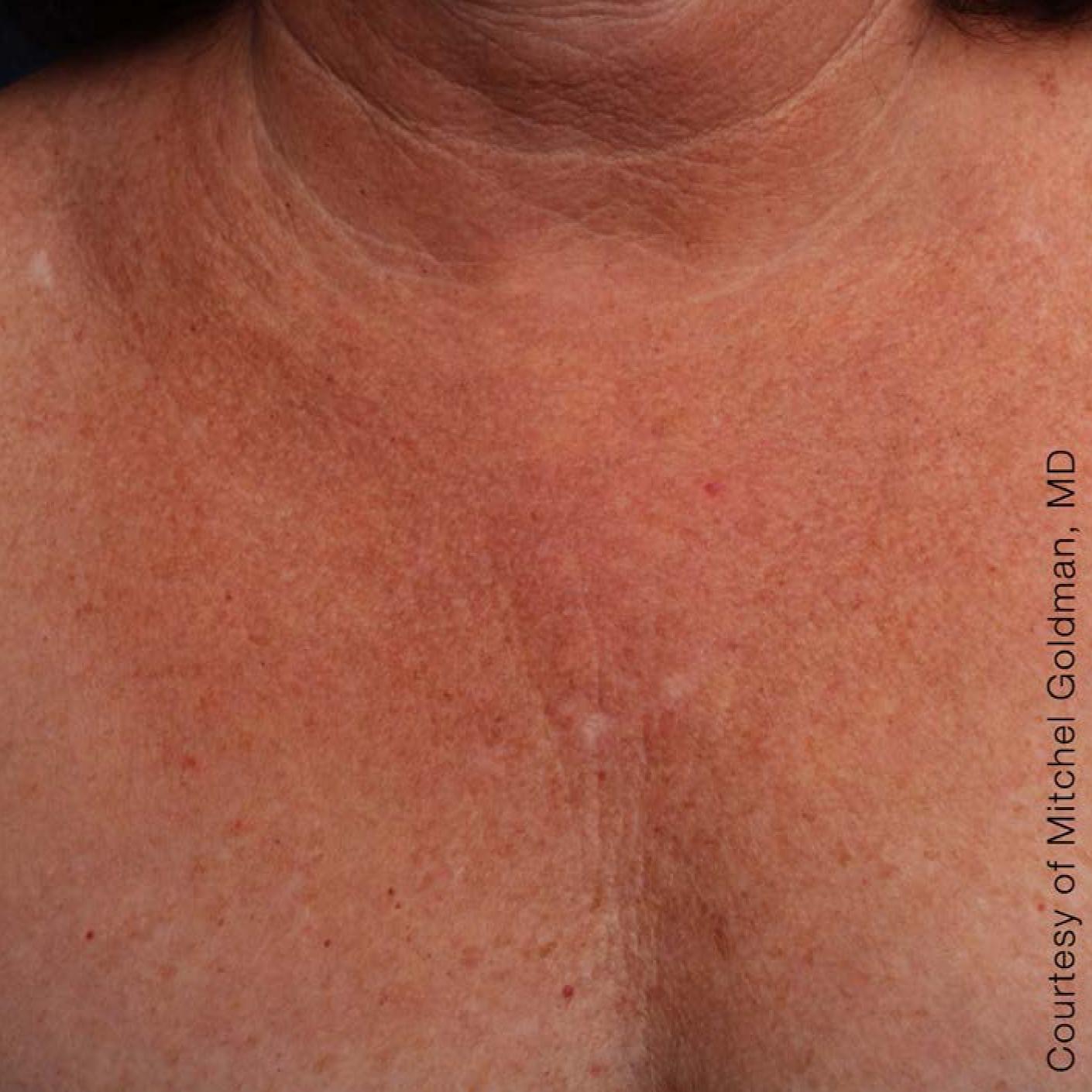 Ultherapy® - Décolletage: Patient 11 - After 