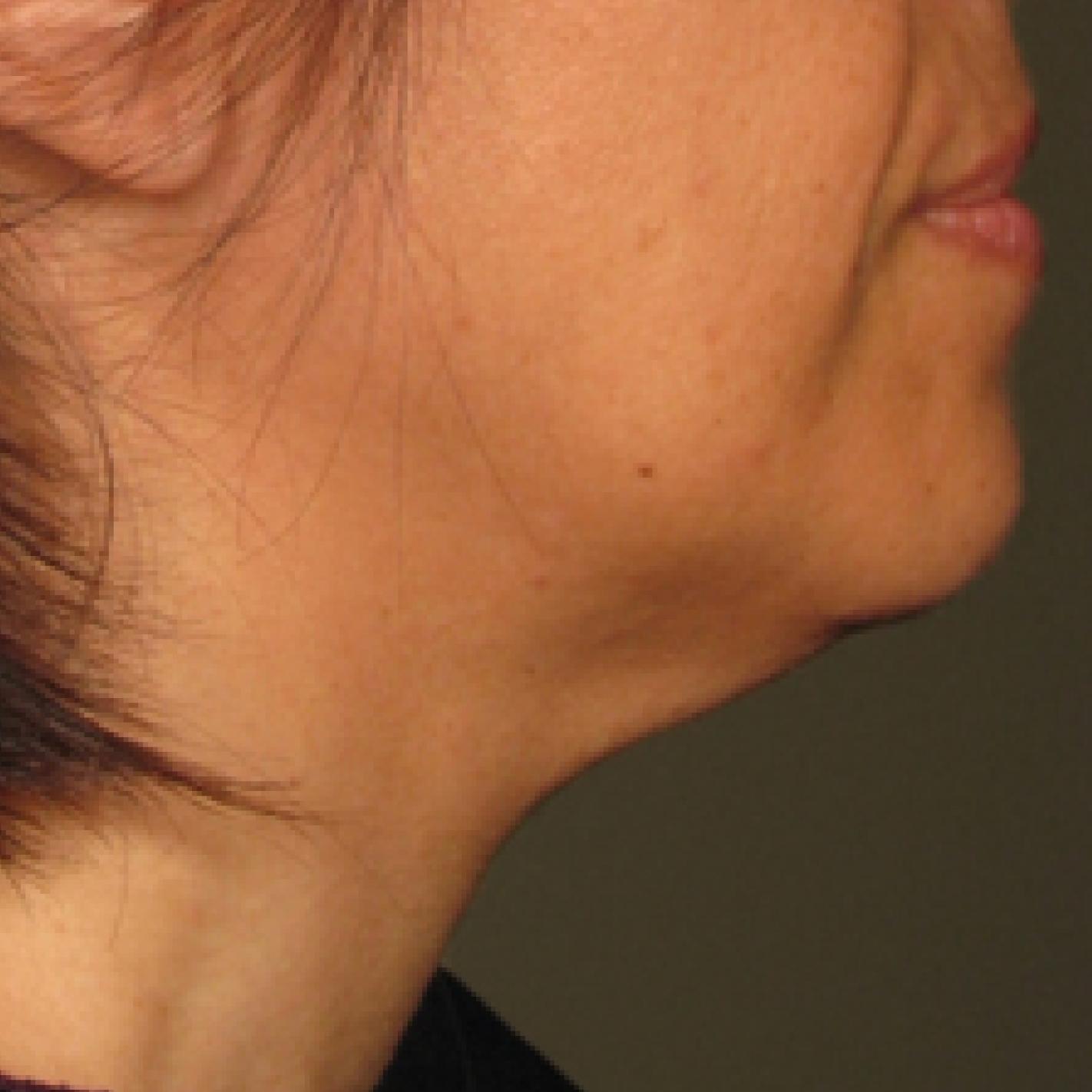 Ultherapy® - Chin: Patient 14 - After 