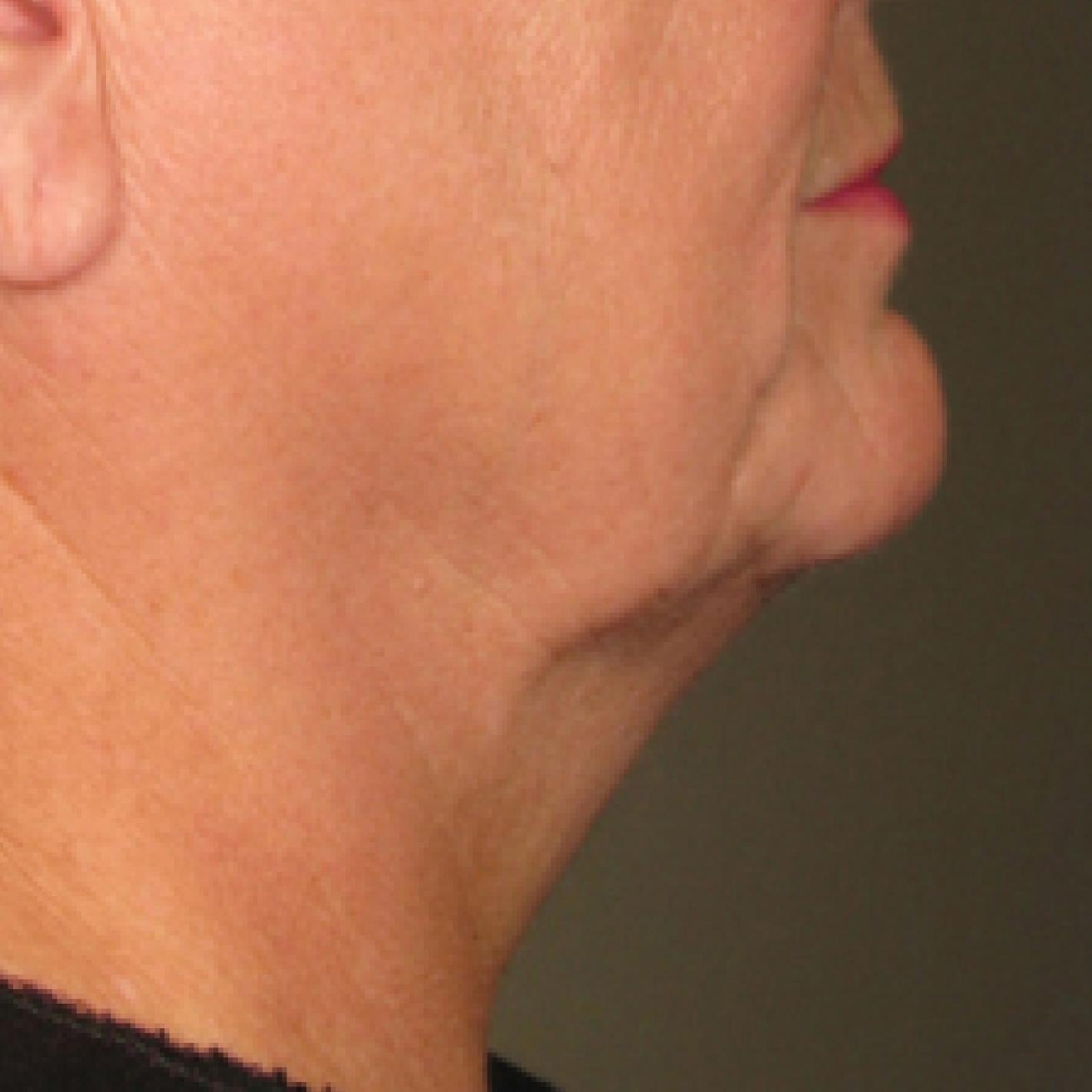 Ultherapy® - Chin: Patient 13 - Before 
