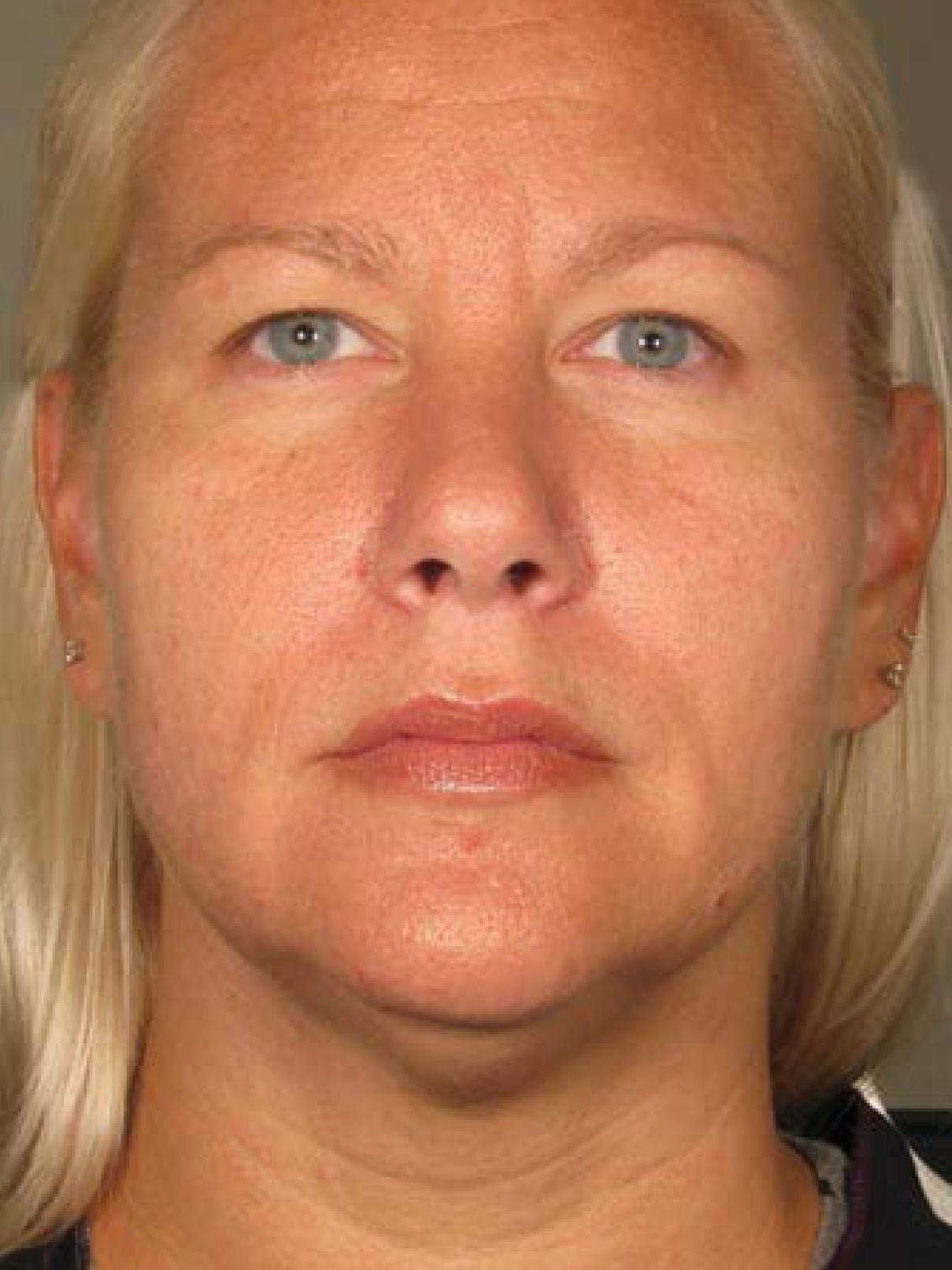 Ultherapy® - Face: Patient 16 - After 1