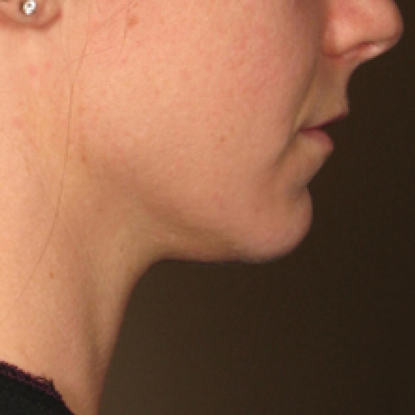 Ultherapy® - Chin: Patient 15 - After 1