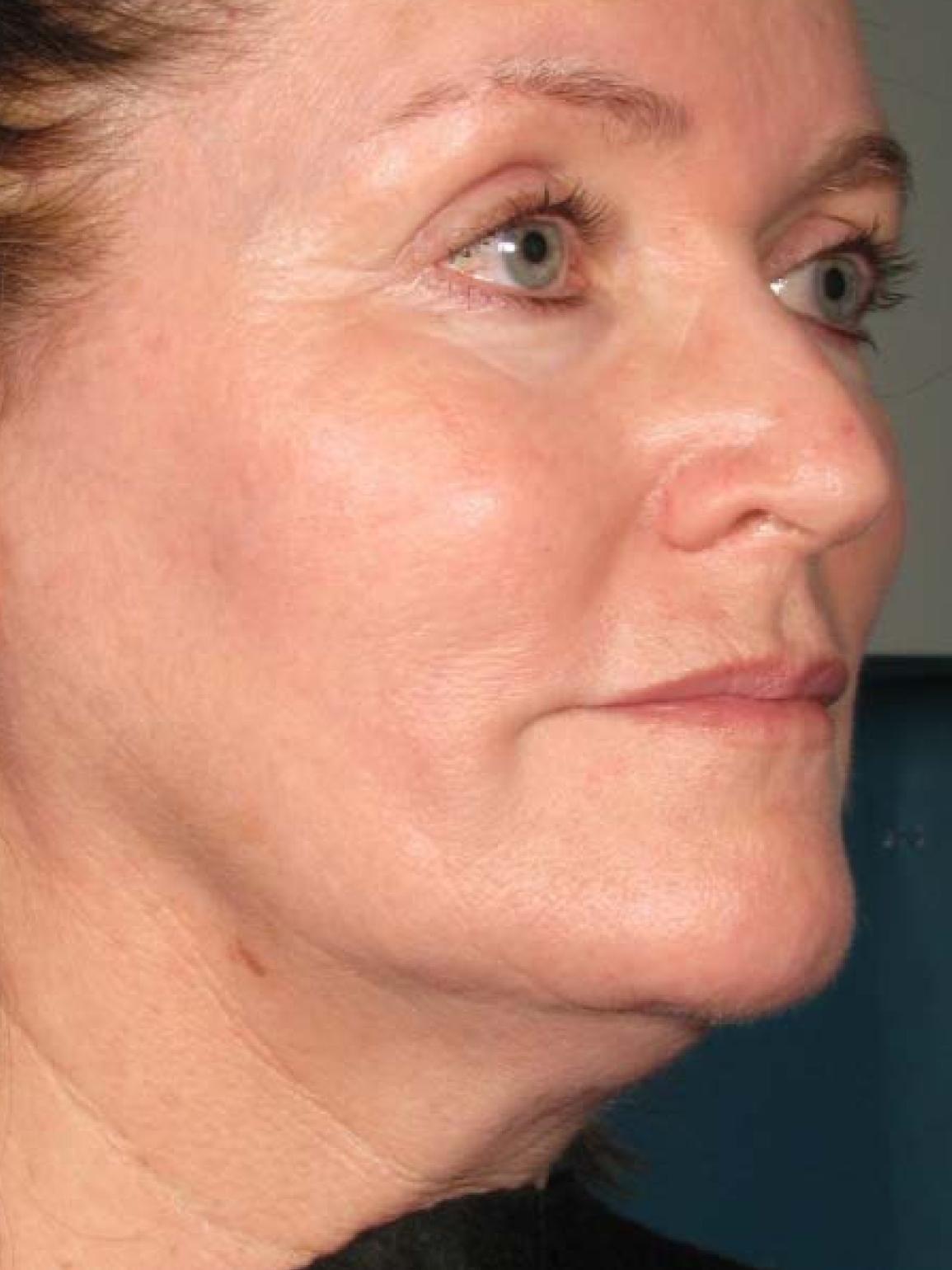 Ultherapy® - Face: Patient 22 - Before 