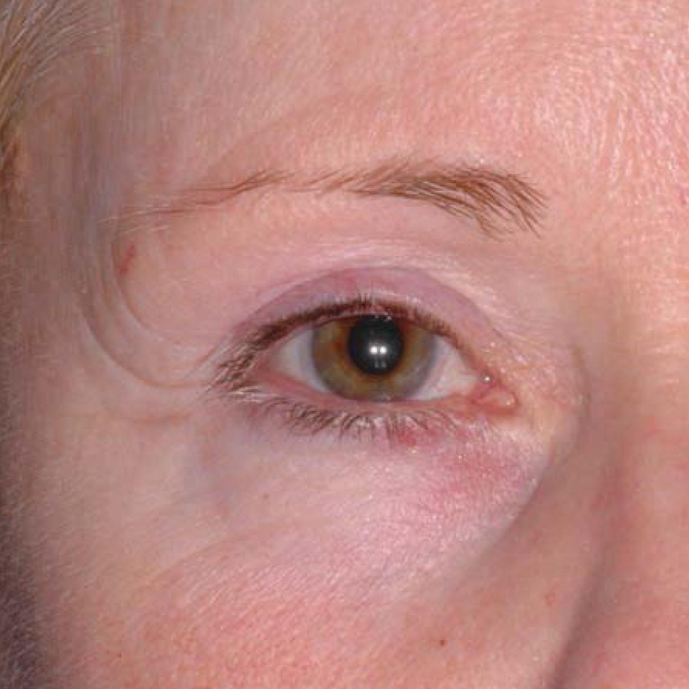 Ultherapy® - Brow: Patient 7 - After 1