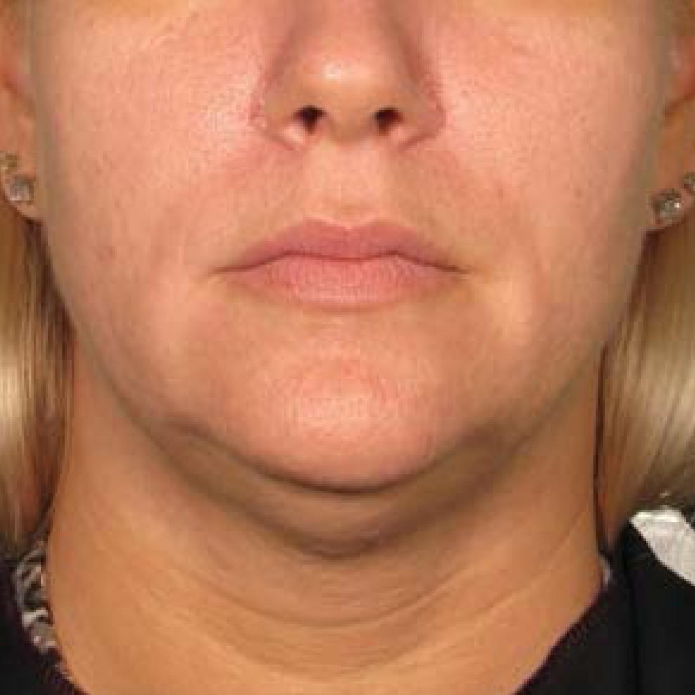 Ultherapy® - Chin: Patient 29 - Before 1