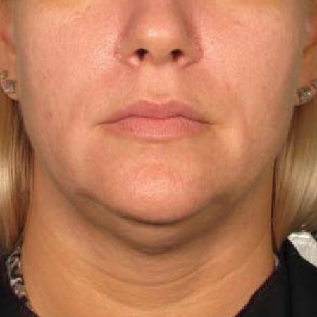 Ultherapy® - Chin: Patient 29 - Before Image