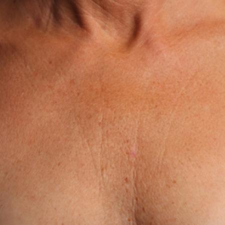 Ultherapy® - Décolletage: Patient 10 - Before 
