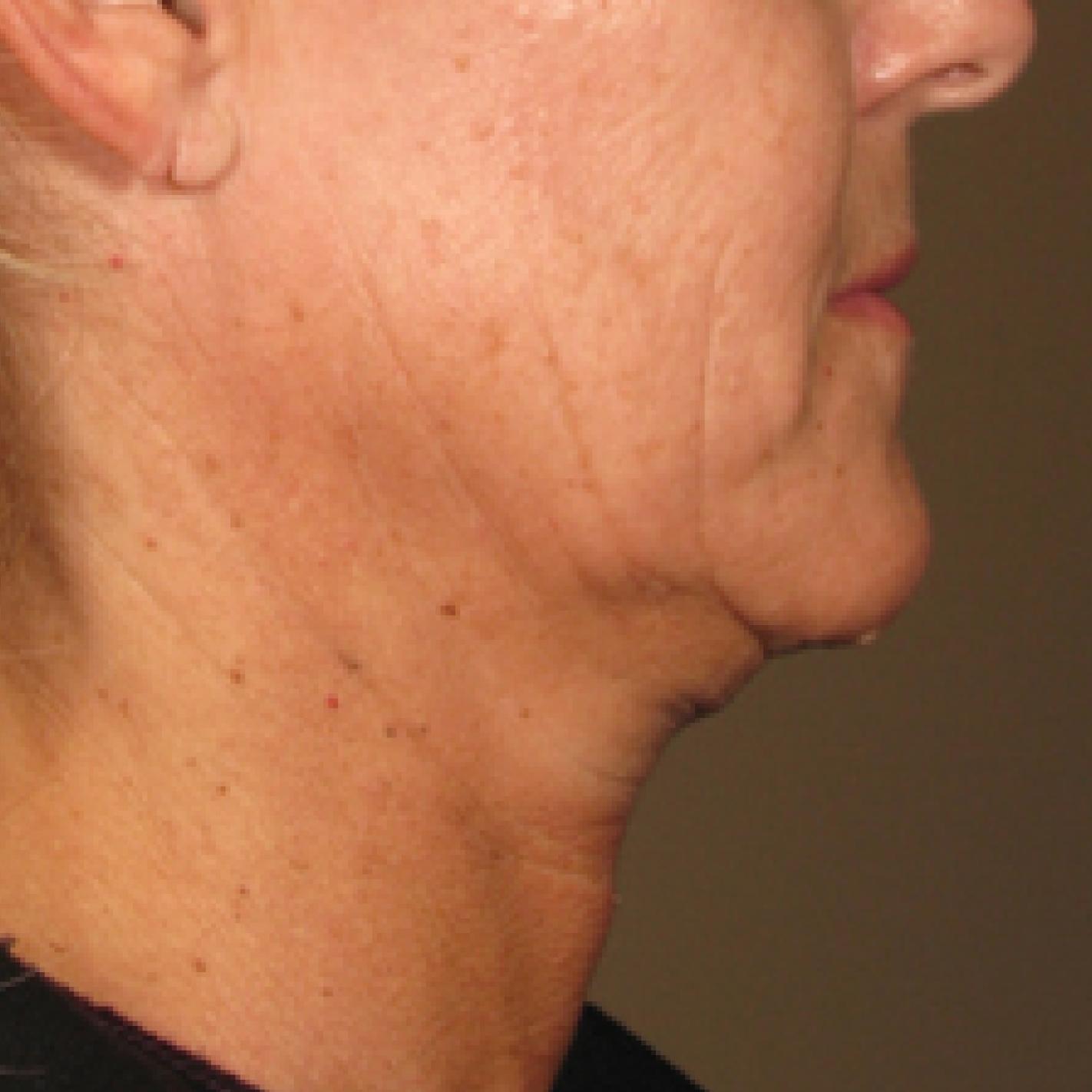 Ultherapy® - Chin: Patient 2 - Before 