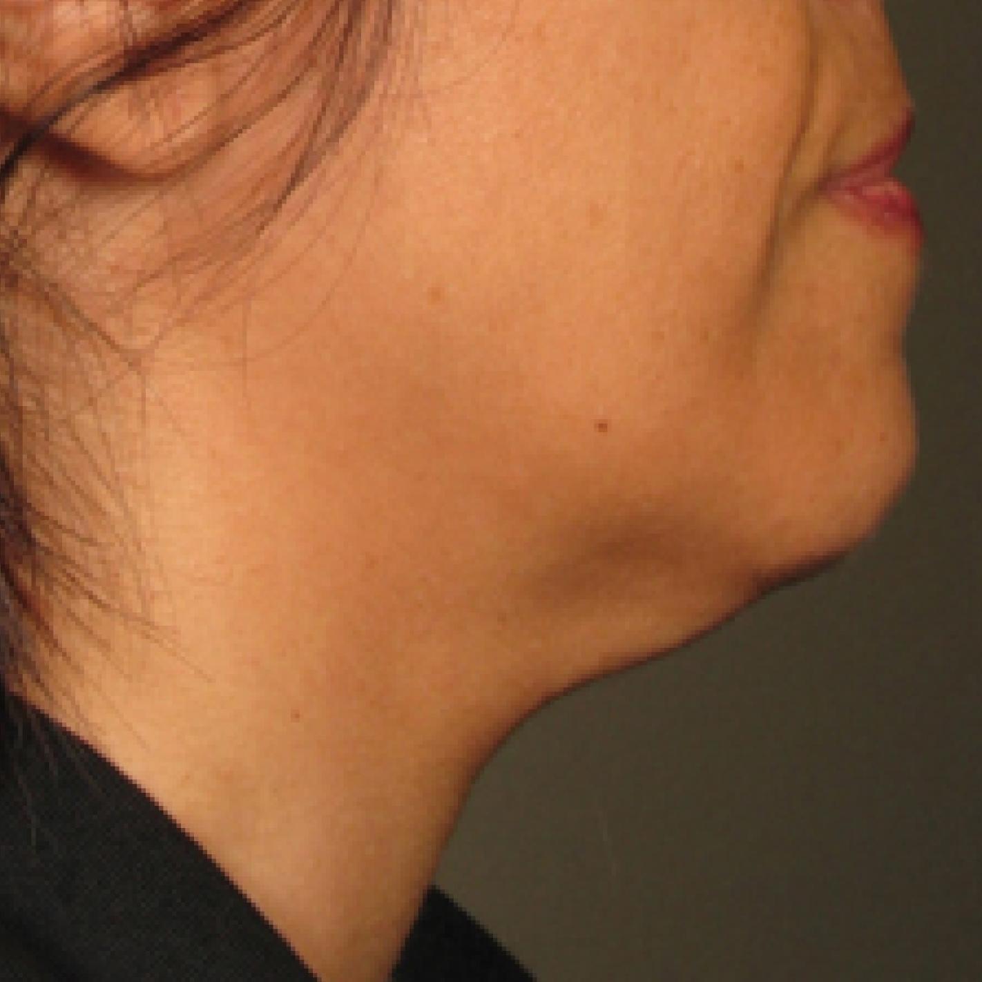 Ultherapy® - Chin: Patient 14 - Before 