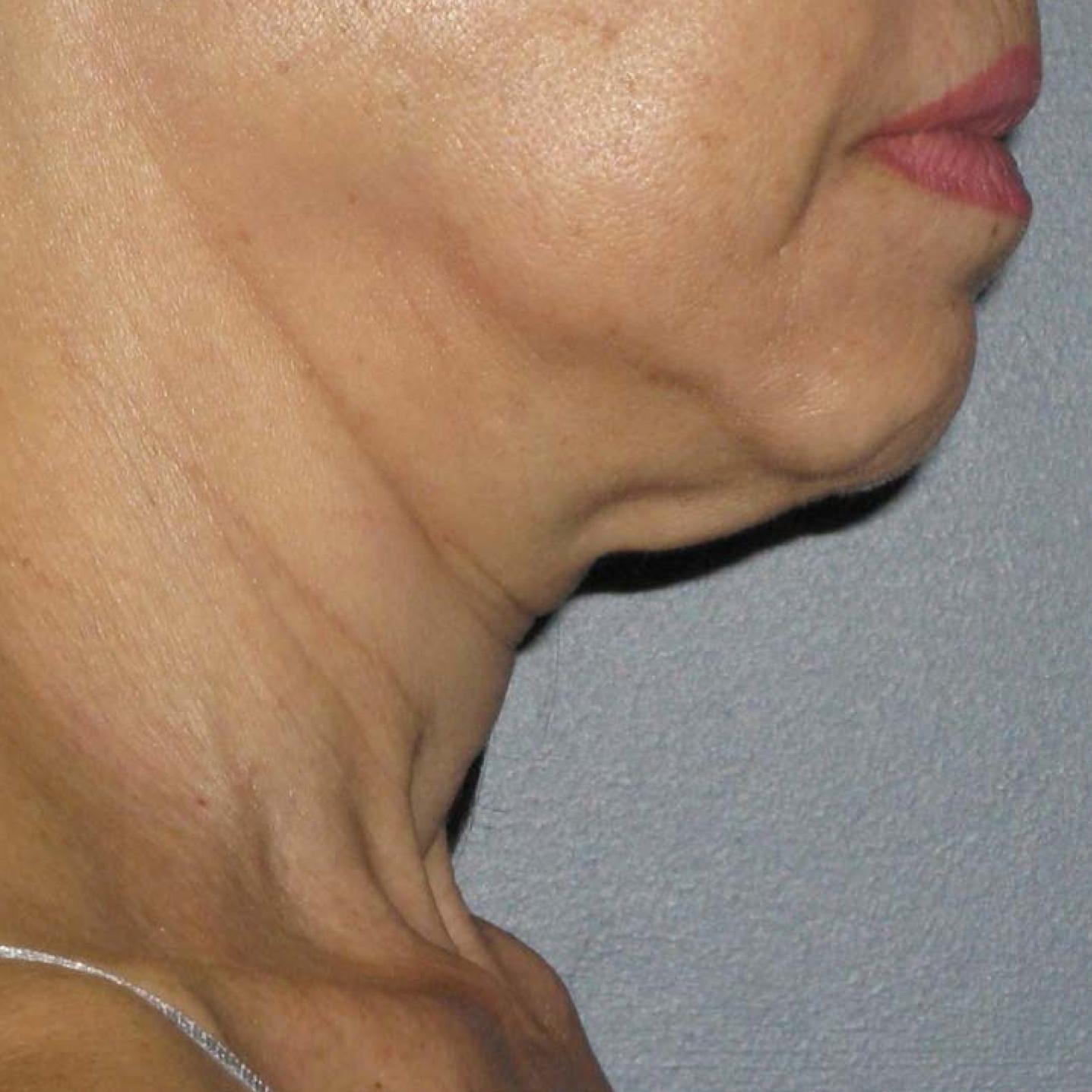Ultherapy® - Neck: Patient 8 - Before 