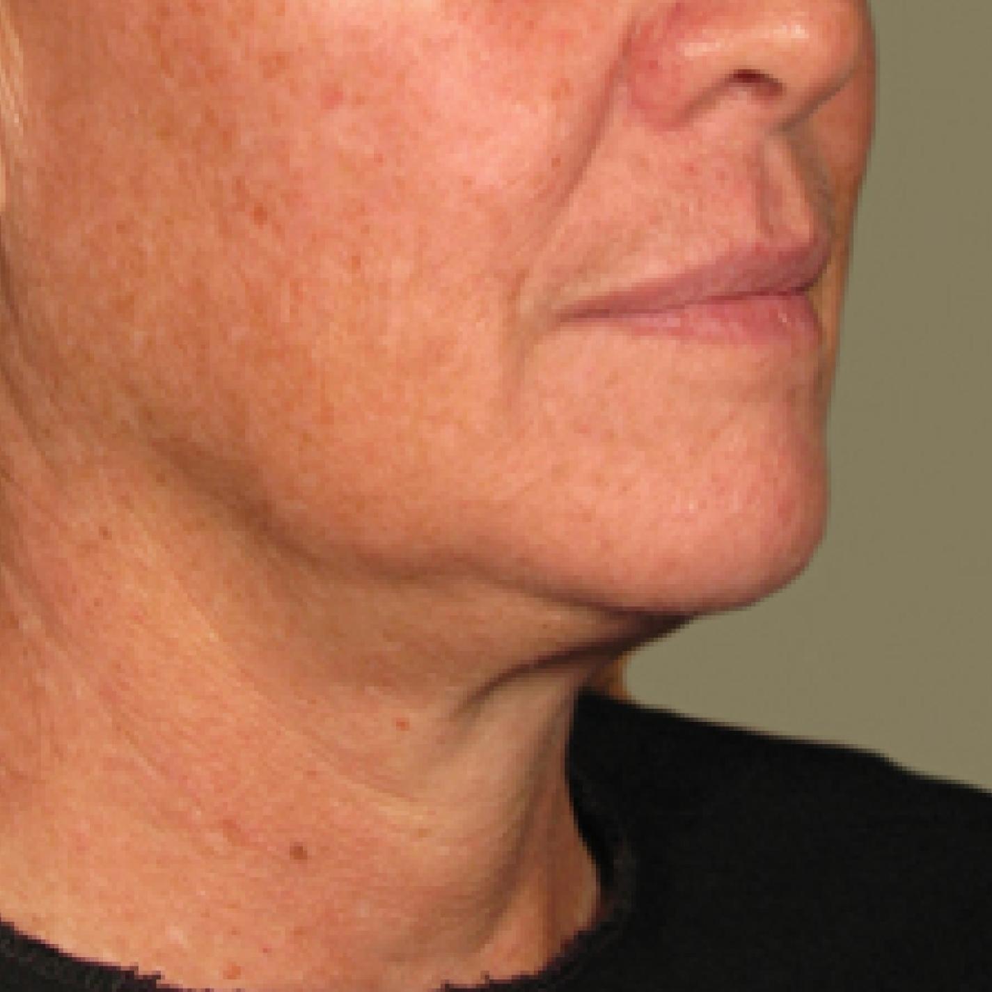 Ultherapy® - Chin: Patient 6 - After 1
