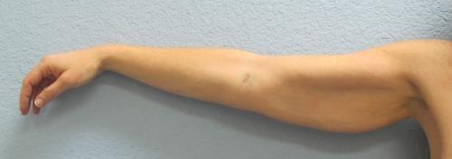 Arm Lift Surgery - Patient 3 - Before 2