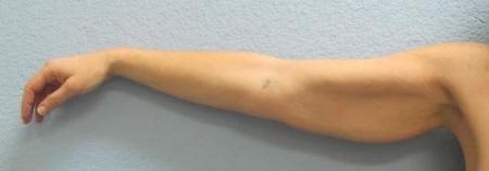 Arm Lift Surgery - Patient 3 - Before Image 2