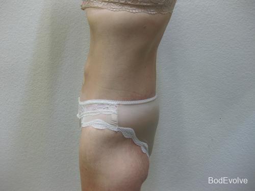 Body Lift - Patient 2 - After 7
