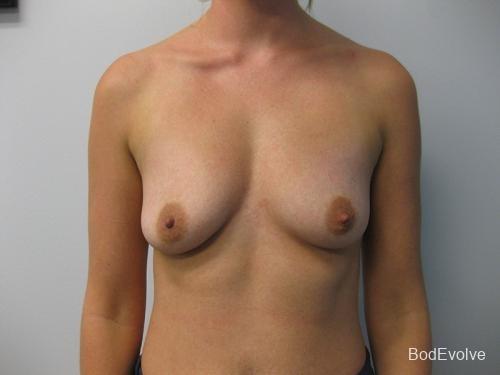 Breast Augmentation - Patient 1 - Before 1