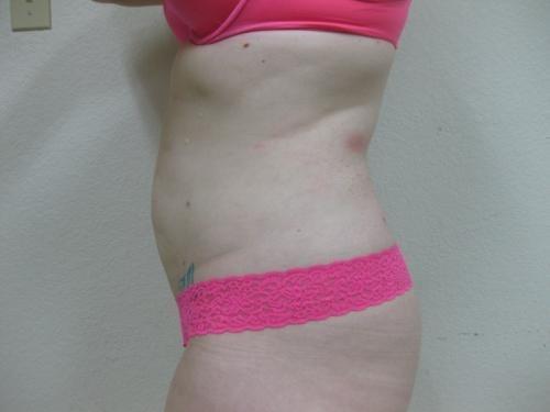 Liposuction - Patient 5 -  After 5