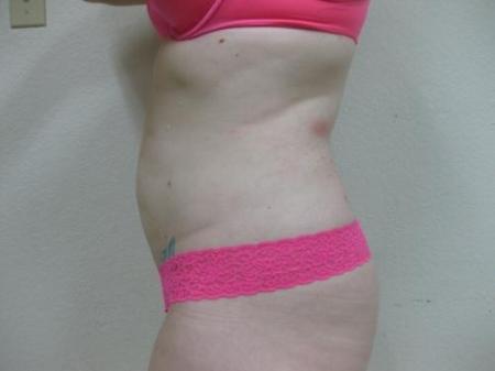 Liposuction - Patient 5 - After Image 5