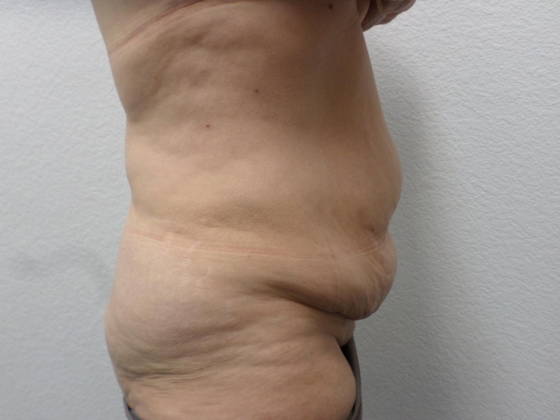 Tummy Tuck: Patient 29 - Before and After 5