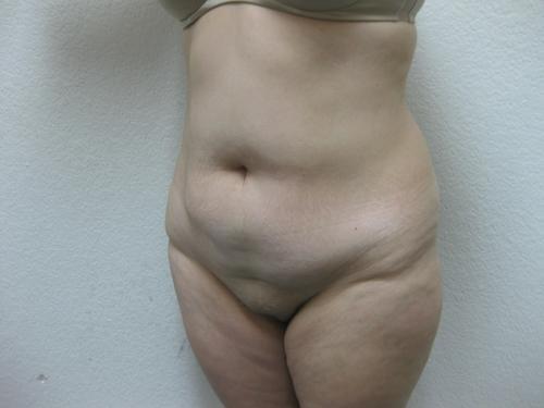 Liposuction - Patient 3 - Before 2