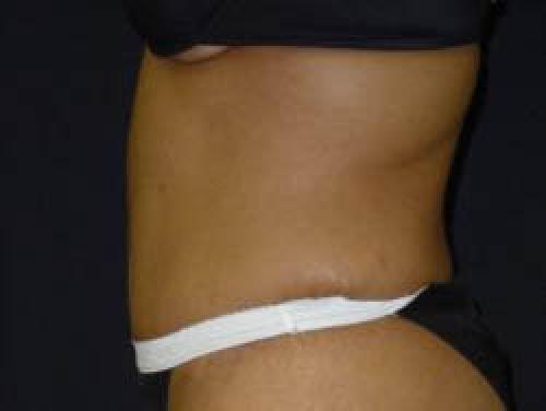 Tummy Tuck - Patient 9 -  After 3