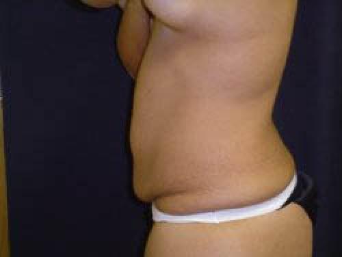 Tummy Tuck - Patient 9 - Before and After 3