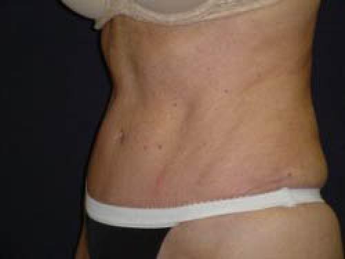 Tummy Tuck - Patient 8 -  After 2