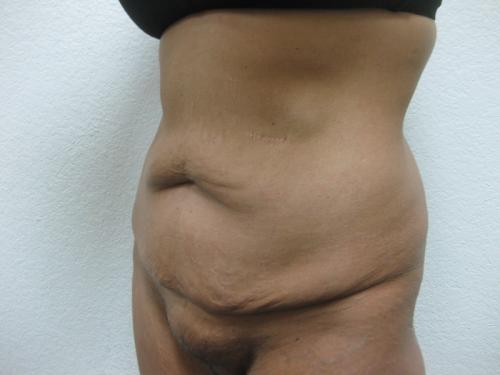 Tummy Tuck - Patient 2 - Before 3