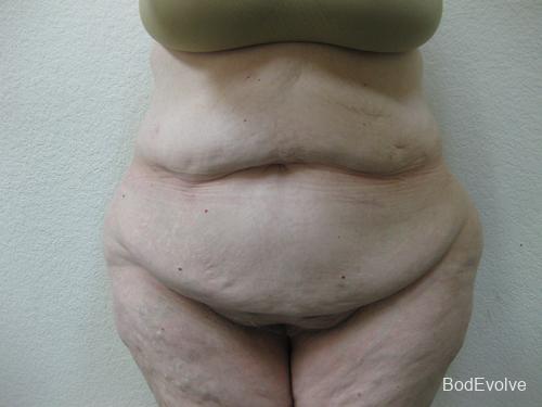Patient 7 - Cosmetic Surgery After Massive Weight Loss - Before