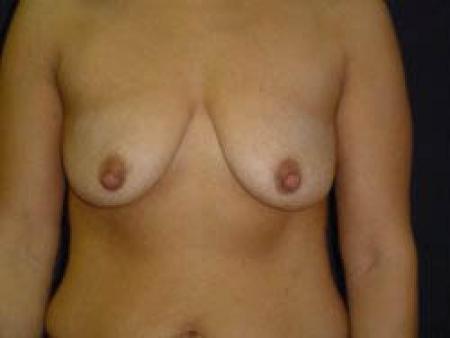 Breast Augmentation with Lift - Patient 3 - Before