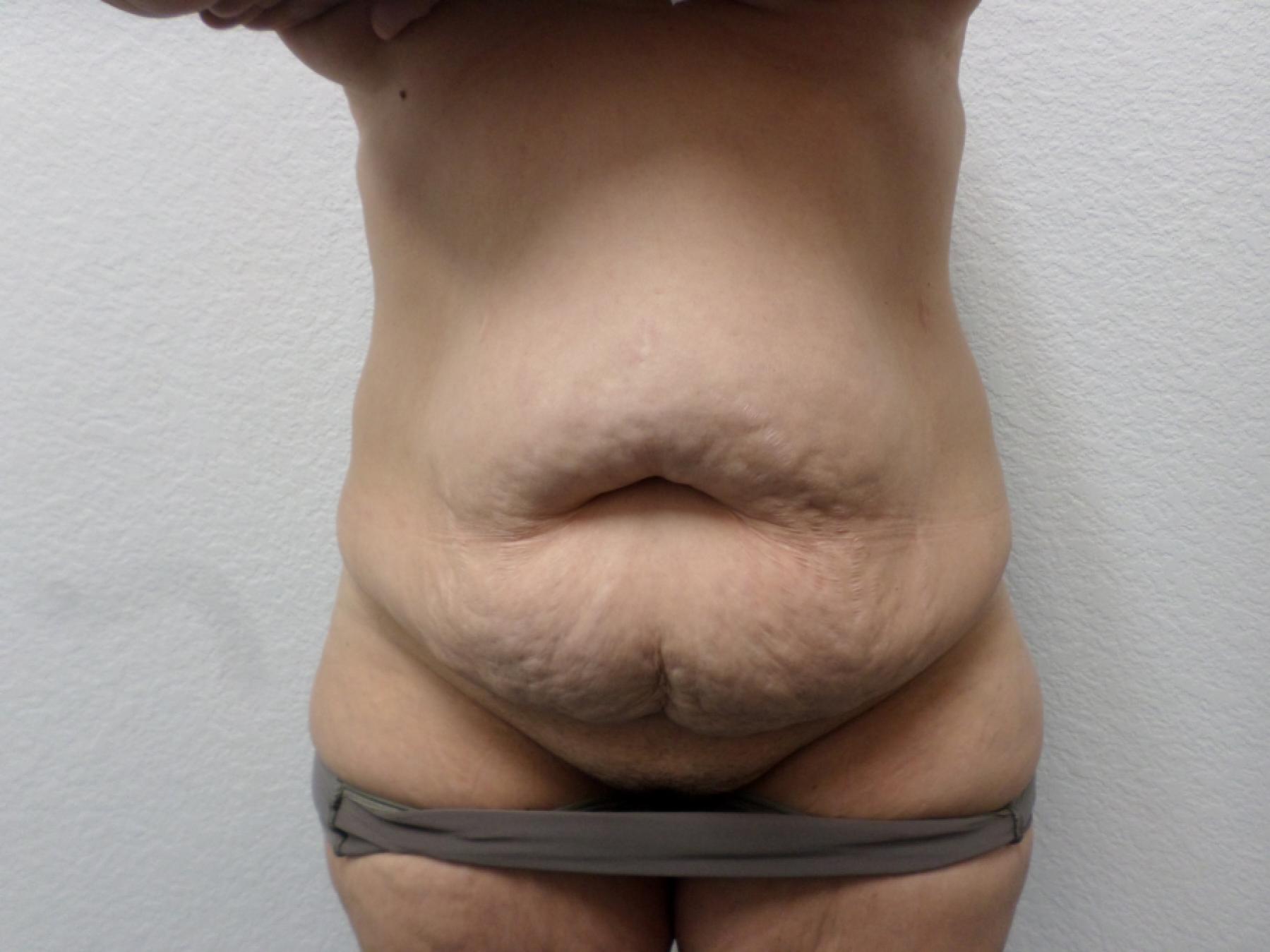 Tummy Tuck: Patient 29 - Before 1