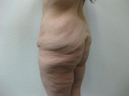 Body Lift - Patient 8 - Before Image 5
