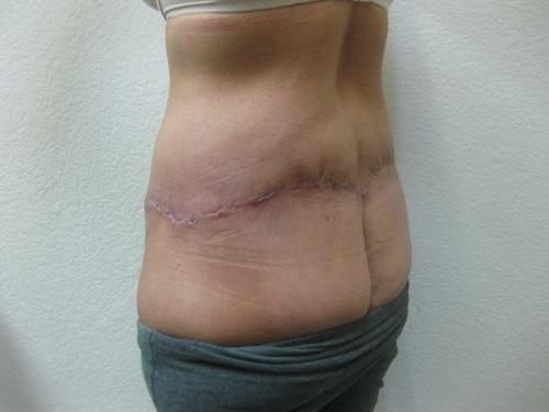 Patient 25 - Cosmetic Surgery After Massive Weight Loss -  After 4