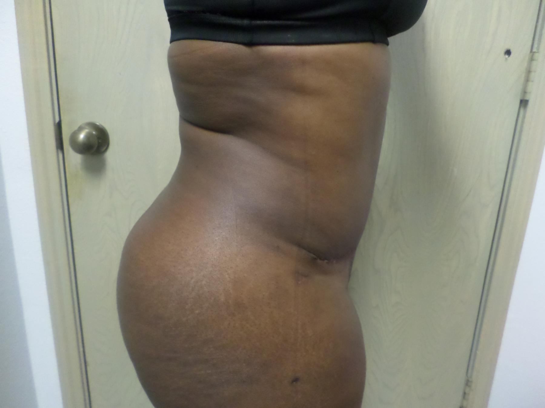 Liposuction: Patient 14 - After 5