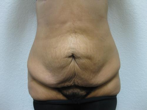 Patient 11 - Cosmetic Surgery After Massive Weight Loss - Before