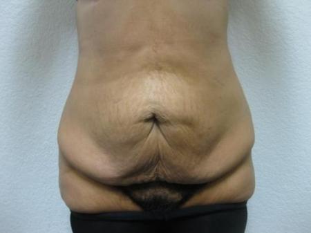 Patient 11 - Cosmetic Surgery After Massive Weight Loss - Before