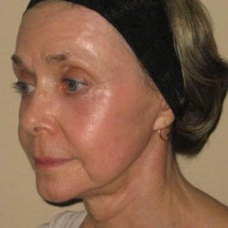 Facelift - Patient 2 - After Image 3