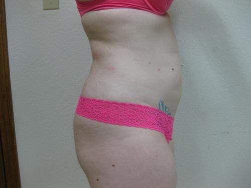 Liposuction - Patient 5 -  After 2