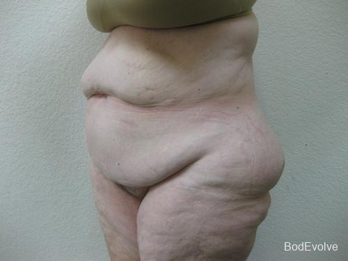 Patient 7 - Cosmetic Surgery After Massive Weight Loss - Before 2